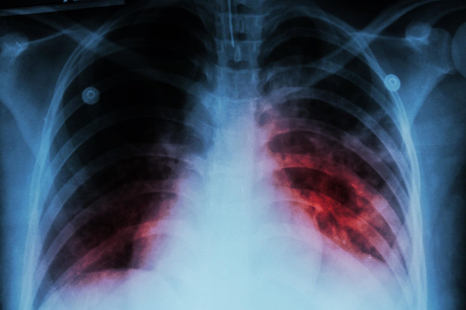 Tuberculosis Exposure Espoo