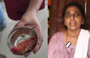Surgical Sponge Left Inside Woman’s Abdomen Sparks Clinical Negligence Allegations Against Kerala Hospital Surgical Sponge Left Inside Woman's Abdomen Sparks Clinical Negligence Allegations Against Kerala Hospital